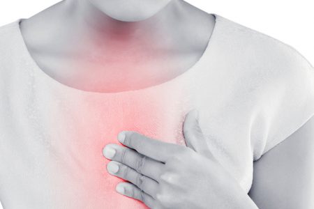 Gastroesophageal Reflux Disease