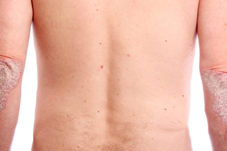 Psoriasis – Causes, Siddha Treatment