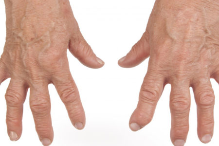 Siddha Treatment for Rheumatoid Arthritis